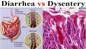Common symptoms of diarrhea include frequent, watery stools, abdominal cramping, and bloating. Differences Between Diarrhea And Dysentery