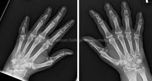 Psoriatic Arthritis Arthritis Mutilans Hand Psoriatic Arthritis Psoriatic Arthritis