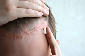 Cerave sa lotion for rough & bumpy skin at amazon. Scalp Psoriasis What Is The Best Home Treatment Elithair