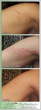 conceal stretch marks with makeup