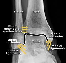 Related online courses on physioplus. Ankle X Rays