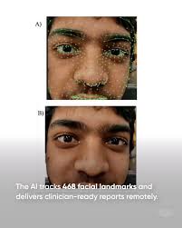 Florida Atlantic researchers have developed a ✨groundbreaking✨ AI model  that brings speed, accuracy and convenience to diagnosing involuntary,  rhythmic eye movements, called nystagmus — all in real time. By combining  deep learning