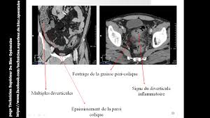 Quels sont les différents types. Maladie Diverticulaire L Instrumentiste Tunisien Des Articles Des Photos Forum