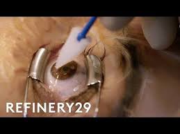 Watch One Patient Try Lasik Eye Surgery And Go Through The Recovery After Lasik Eye Surgery Laser Eye Surgery Eye Surgery