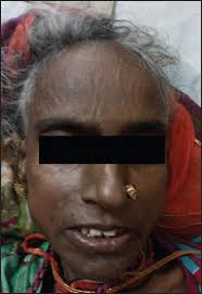 A rare case of occult abdominal tuberculosis with Poncet's disease  mimicking Adult onset Still's disease.