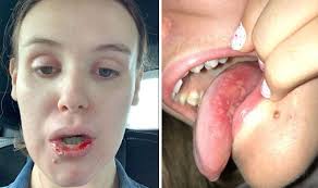 Image result for mouth ulcer on tongue)