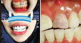 Adanya gigi yang berjarak, gigi veneer gigi memang memiliki banyak manfaat, tapi di sisi lain veneer gigi juga memiliki banyak. Fake Veneer Ini Ibarat Lantai Berlumut Doktor Ini Jelas Risiko Putihkan Gigi Remaja