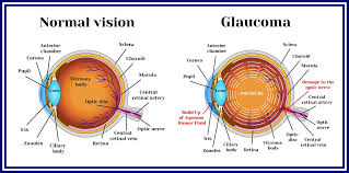 If you have the condition, you'll. Glaucoma Treatment Fort Lauderdale Eye Institute