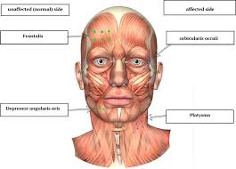 Eye care may include eye drops during the day, ointment at bedtime, or a moisture chamber at night. Bell S Palsy Aetiology Clinical Features And Multidisciplinary Care Journal Of Neurology Neurosurgery Psychiatry