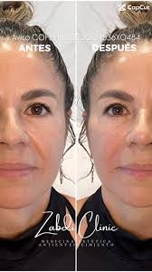 LIFTING FACIAL LÍQUIDO 💦, CON ÁCIDO HIALURÓNICO, El lifting facial con  ácido hialurónico, no se trata sólo de “Rellenar” se trata de identificar  las zonas del rostro donde se han perdido los puntos de ...