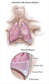 The space between the layers normally contains a thin layer of fluid. 17 Pleural Effusion Ideas Pleural Effusion Respiratory Therapy Pulmonology