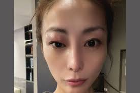 クインケ 浮腫 目