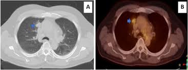 Pet Positive Lung Mass In A Patient With Rectal Cancer Bmj Case Reports
