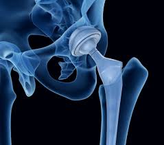 It S Been A Rocky Week Emotionally I M Not Going To Lie Had Some Highs This Week Like Walking I Hip Replacement Surgery Hip Replacement Total Hip Replacement