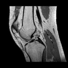 This webpage presents the anatomical structures found on knee mri. Normal Knee Mri Radiology Case Radiopaedia Org