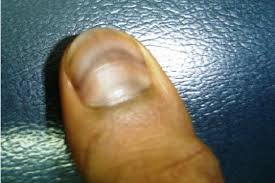 Image result for Muehrcke Line