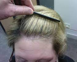 Thyroid Hair Loss Regrowth Hair Loss Regrowth Thyroid Thyroid Hair Loss Regrowth Hair Loss Regrowth Thyroid Hair Loss Thyroid Hair