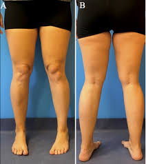 Image result for In-Toeing