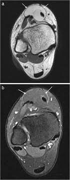 Foot muscle forces & deformities. Mri Imaging Of Soft Tissue Tumours Of The Foot And Ankle Springerlink