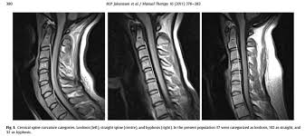 ¿qué es el dolor cervical? Novafisium La Famosa Rectificacion Cervical