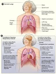 Pin By Respiratorycarestore Com On Respiratory Distress Syndrome Respiratory Care Respiratory Medical Education