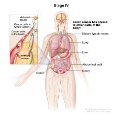 Situated in the upper half of the abdomen, the pancreas is part of the digestive system. Colon Cancer Hematology Oncology Associates Of Cny