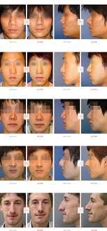 Maybe you would like to learn more about one of these? Male Rhinoplasty Vip Plastic Surgery Korea