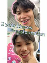 Braces Journey: My Experience with Traditional Metal Braces