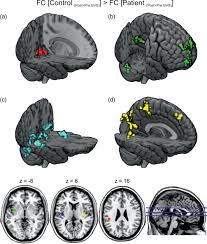 There are many varieties of masks. Effects Of Galvanic Vestibular Stimulation On Resting State Brain Activity In Patients With Bilateral Vestibulopathy Helmchen 2020 Human Brain Mapping Wiley Online Library