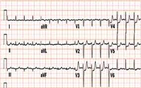 Image result for Unstable Angina