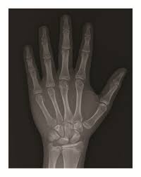 Solved: The Presence Of An Epiphyseal Plate Indicates That Bone Diameter Is  Widening. Bone Length [Biology]