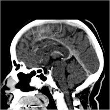 The cavernous sinus is one of the several cerebral veins and cavernous sinus thrombosis is a specific type of cerebral venous (sinus) thrombosis. Cerebral Venous Sinus Thrombosis In A Young Female Misdiagnosed As Migraine Ending In A Permanent Vegetative State A Case Report And Review Of The Literature Journal Of Medical Case Reports