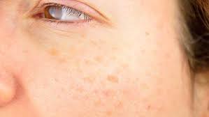 Adakalanya, muka anda berjerawat ditambah lagi dengan masalah blackhead yang serius?? 7 Penyebab Flek Hitam Di Wajah