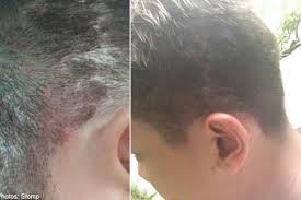Chemical burns on the scalp also can occur from leaving the hair wrapped in foil under the dryer for an extended period. Man Suffers Scalp Infection After Salon Over Bleaches His Hair Health Health News Asiaone