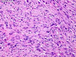 Check spelling or type a new query. Webpathology Com A Collection Of Surgical Pathology Images