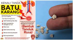 Apabila tubuh badan tidak mencukupi air untuk melarutkan asid. Batu Karang Kidney Stone Sakit Menggigil Macam Nak Bersalin Punca Tanda Rawatannya