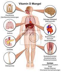 Eine seiner hauptaufgaben ist die knochengesundheit. Vitamin D Mangel Anzeichen Und Symptom Vektor Illustration Fototapete Fototapeten Sklerose High Blutdruck Mangel Myloview De