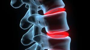 Wichtige erkankungen der halswirbelsäule sind traumen, degenerative veränderungen und funktionelle überlastungen, z.b. Das Schleudertrauma Sportmedizin Sportverletzung