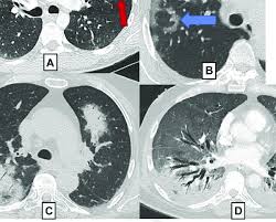 Sara tomassetti, claudia ravaglia, venerino poletti. A D Five Patterns Of Lung Parenchymal Involvement A Download Scientific Diagram