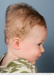 Image result for Positional Head Deformity