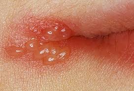 Cold Sore Picture Image On Medicinenet Com