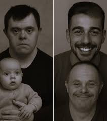 Father with down syndrome raises son to be dentist