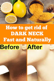 Get Rid Of Dark Neck Fast And Naturally Black Neck Skin Brightening Beauty Tips For Hair