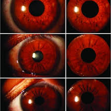 Total Visualization Of Representative Iris Color And Pattern