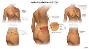 Poland syndrome is a birth defect characterized by an underdeveloped chest muscle and short webbed fingers on one side of the body. Lap Flap Breast Reconstruction Dr Tanna