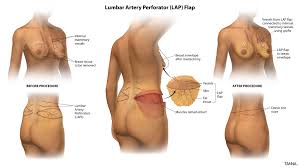 900 x 817 jpeg 99 кб. Lap Flap Breast Reconstruction Dr Tanna