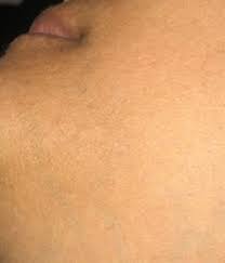 Years of proven results is what you'll find with laura j. Electrolysis Nyc Hairless Nyc