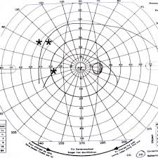 Manual Perimeter An Overview Sciencedirect Topics