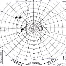 Manual Perimeter An Overview Sciencedirect Topics