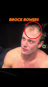 Why Is Brock Bowers Balding